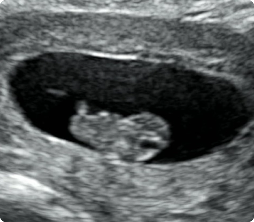 DNA Gender Testing with Mini 2D Ultrasound